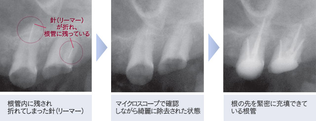 根管治療のメリット