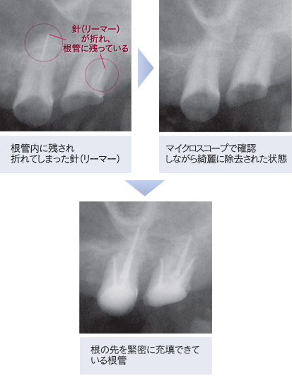 根管治療のメリット