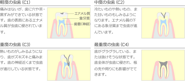 虫歯かな？と思ったら　虫歯チェック