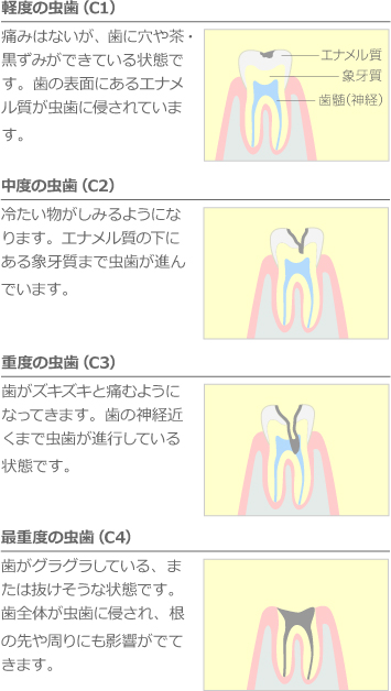 虫歯かな？と思ったら　虫歯チェック