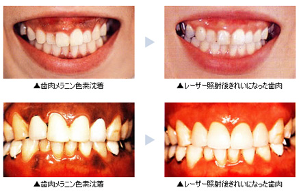 レーザーで歯の白さを手に入れる